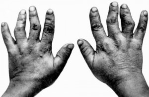Деформация кистей рук при болезни Кашина-Бека (уровская болезнь)